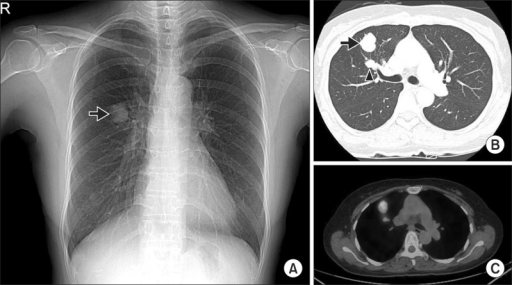 A Chest X Ray Shows A Nodule Arrow In The Right Middl Open I