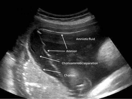 chorionic villi ultrasound