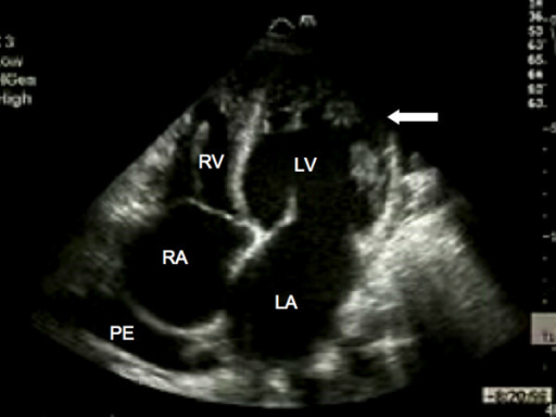 Transthoracic echocardiography. Apical four chamber vie | Open-i