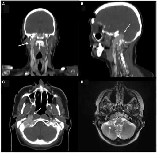 Glomus jugulare tumour. Coronal (A), sagittal (B) and a | Open-i