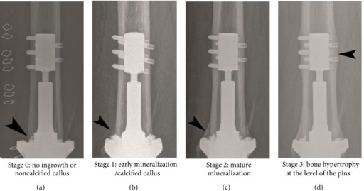 Radiographic Stages Of Osseointegration According To Th | Open-i