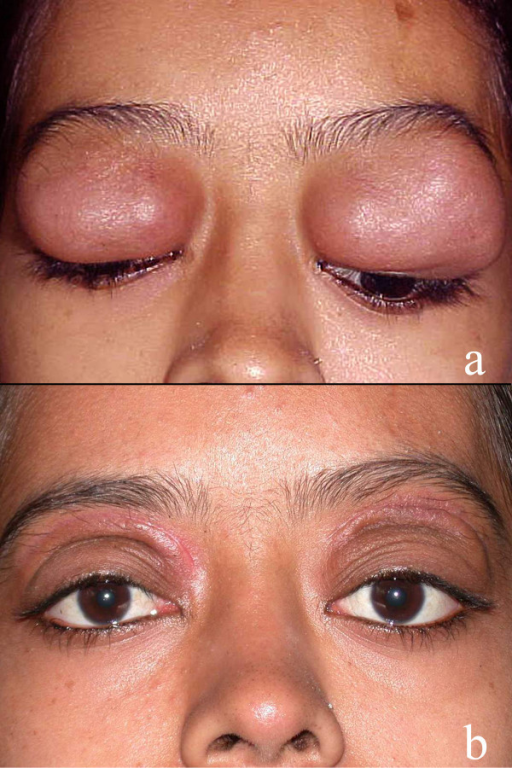 Bilateral upper eyelid and preseptal orbital mass in a Open-