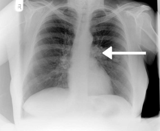 Chest radiograph showing left hilar abnormality (arrow) | Open-i