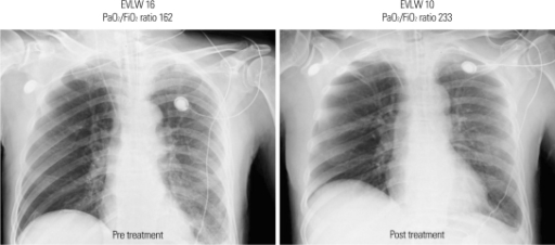 Changes of chest X-ray findings after carperitide thera 