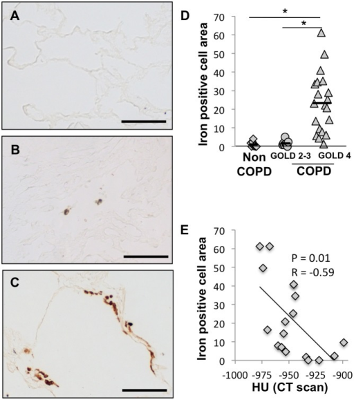 Iron deposits are increased in lungs of COPD subjects.Iron deposits were stained with Perls-DAB staining in lung samples obtained from (A) a patient without COPD, (B) a patient with GOLD 2 COPD and (C) a patient with GOLD 4 COPD. (D) Quantification of iron positive cellular area was performed on lung sections from 8 subjects without COPD, 9 subjects with GOLD 2 or 3 COPD and 20 subjects with GOLD 4 COPD. (E) Correlation between the iron deposits and the mean radiograph attenuation in the same lung area. *p&lt;0.05 (Anova analysis with a Tukey-Kramer post-hoc test); Scale bars = 125 µm.