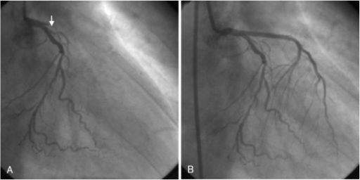 Diagnostic Coronary Angiogram And Primary Percutaneous | Open-i