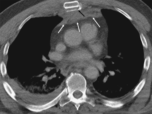 Sternal Fracture Axial Ct Image At Mediastinal Window Open I