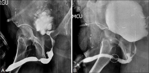 (A) Retrograde Urethrogram Demonstrating A Narrowing In | Open-i