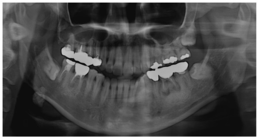 Preoperative panoramic radiography illustrating a radio | Open-i