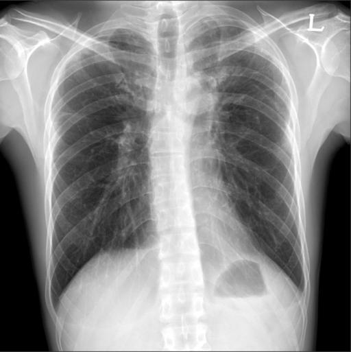 Chest radiography showed bilateral subpleural irregular | Open-i