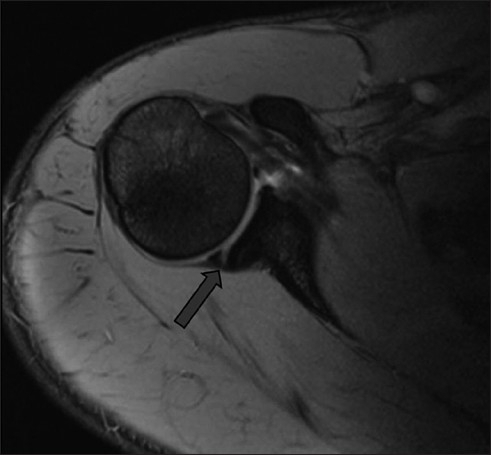 Mri Arthrogram Hip Labral Tear