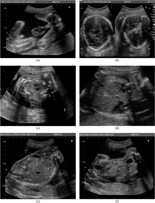 a) Transverse ultrasound sections of the fetal head; no | Open-i