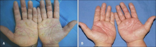 Hyperkeratotic plaques and fi ssures on the palms