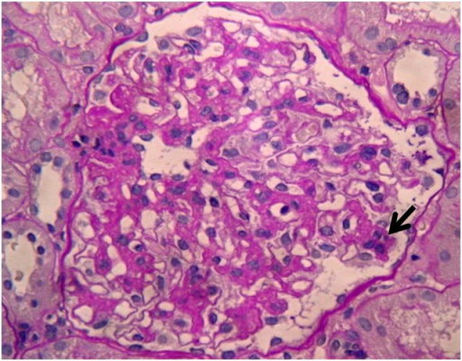 mesangiale proliferative Glomerulonephritis