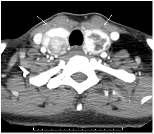 Axial Postcontrast Ct Image Through The Thyroid Gland D Open I 6008