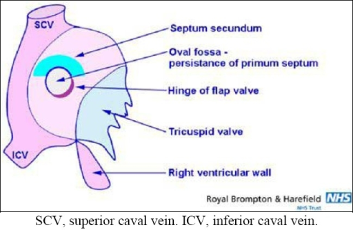 Oval Fossa