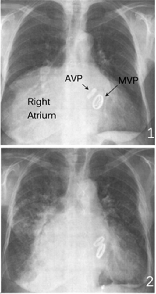 Chest X Ray Findings Preoperative 1 And Postoperativ Open I