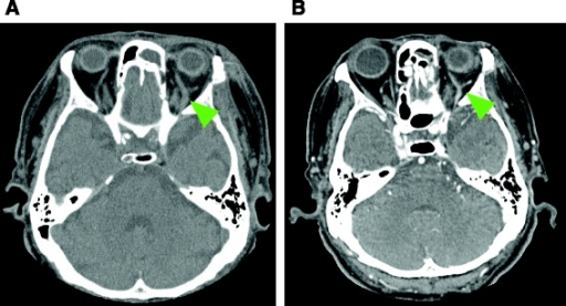 Follow-up computed tomography scan of the superior opht | Open-i