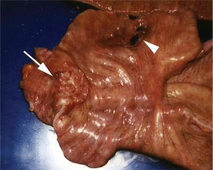 Gross appearance of the resected colon and small intest Gross appearance of the resected colon and small intest