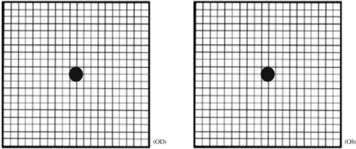 Amsler grid test shows a round scotoma in the central r | Open-i