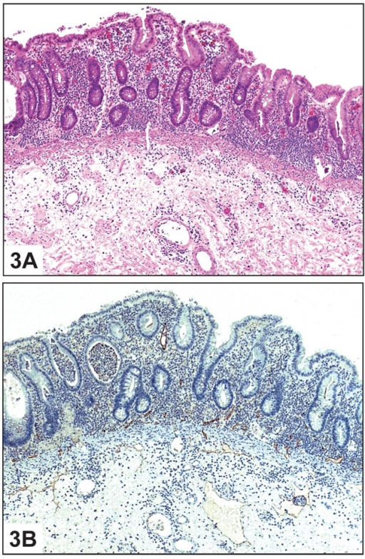 Inflammatory Bowel Disease: A. Histologic Section Of C | Open-i