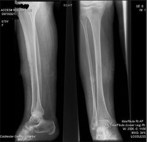 Plain radiograph of right tibia and fibula showing cort | Open-i
