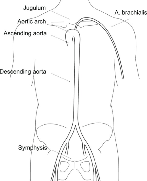 The jugulum–symphisis distance for the superficial mo | Open-i