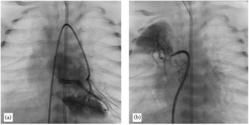 Cardiac catheterization after injection in (a) and (b) | Open-i