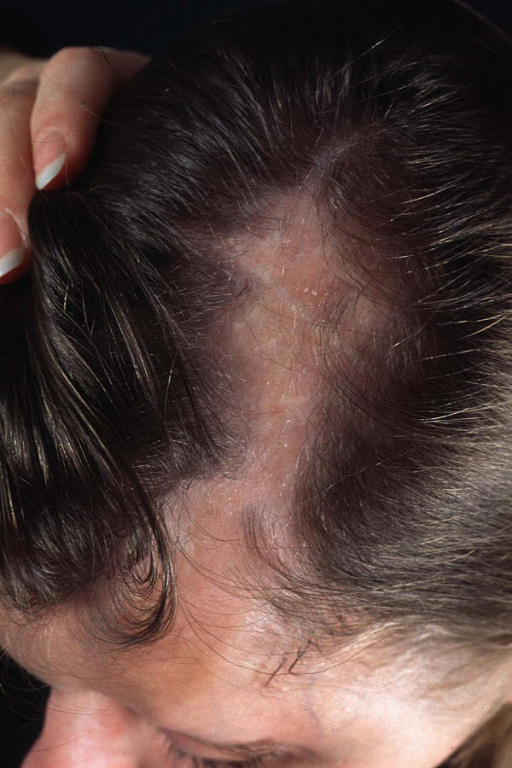 The 23-year-old Woman With Lscs And Cicatricial Alopeci 