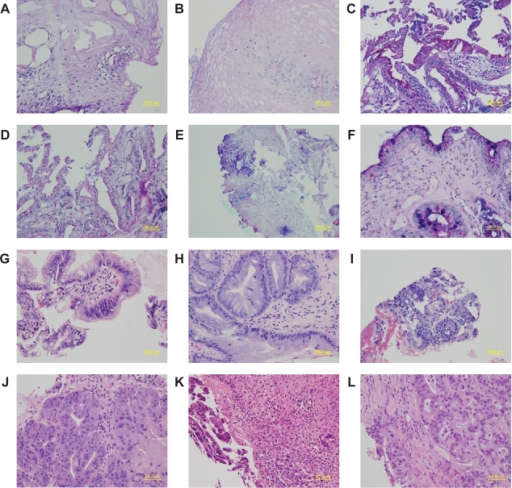 Sections of esophageal epithelium from matched research | Open-i