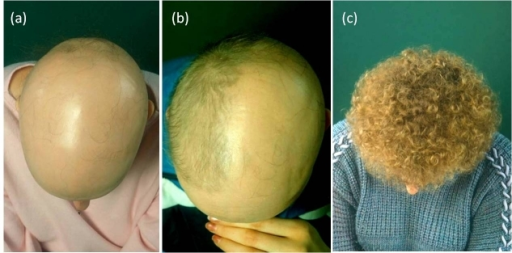 alopecia universalis treatment 2015