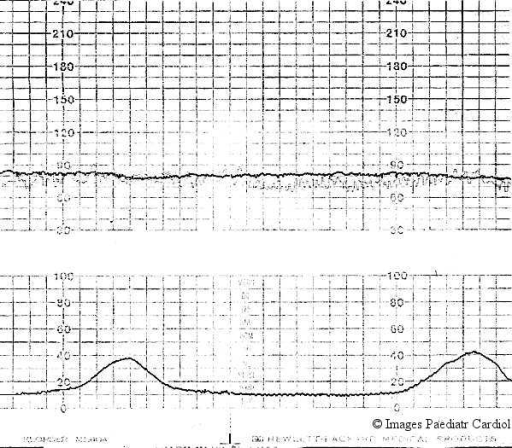 Electronic fetal monitoring tracing in labor with fetal | Open-i