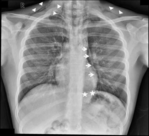 Spontaneous pneumomediastinum seen on a chest radiograp | Open-i