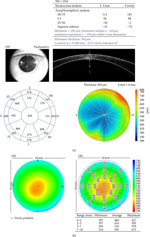 Corneal Pachymetry Conversion Chart