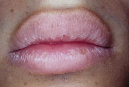 Dry Lips With Scaling And Crusting Particularly Involvi Open I 