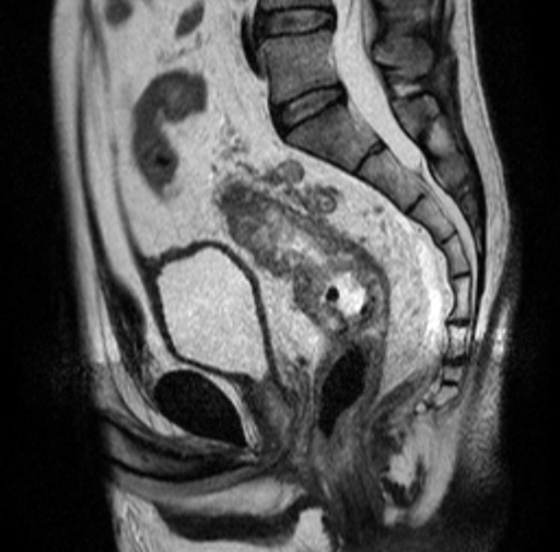 Sagittal Mri Image Showing The Rectal Tumour Commencing Open I 5873