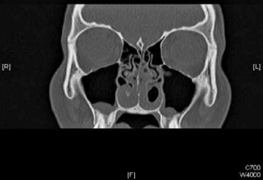 Nasal Turbinates Hypertrophy