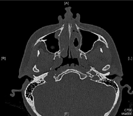 Axial CT scan shows hypertrophic turbinates with left c | Open-i