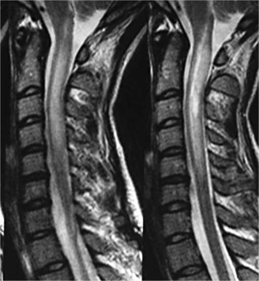 Sagittal T2-weighted Spinal MRI Shows Large Extending L | Open-i