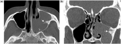 Inverted papilloma. (a) Axial and (b) coronal CT show t | Open-i