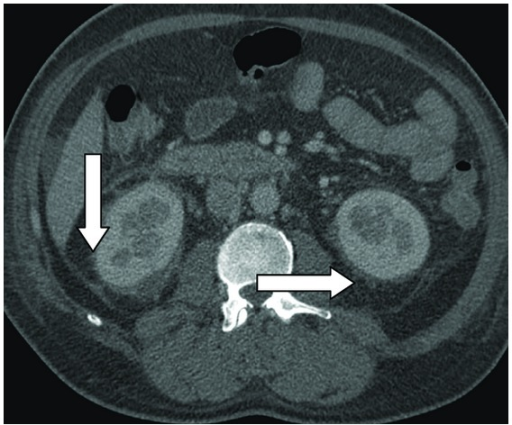 Perinephric Fat Stranding Ultrasound