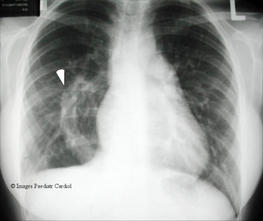 CXR - scimitar vein seen as a curvilinear density along | Open-i