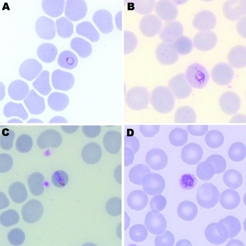 Giemsa-stained thin blood films of patient infected wit | Open-i