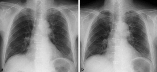 Plain chest X-rays of the patient. a Deep inspiration. | Open-i