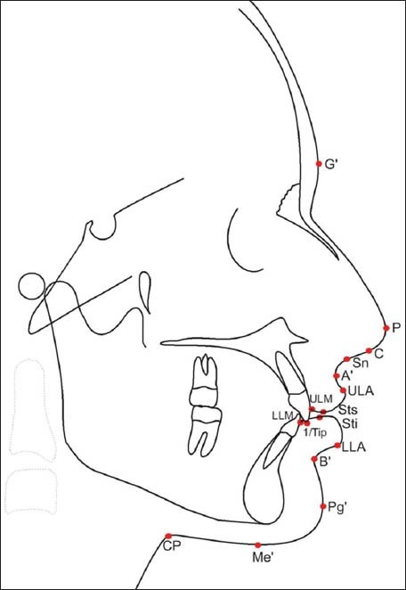 Tracing Of Lateral Cephalogram Showing Soft Tissue Landmarks. Soft ...