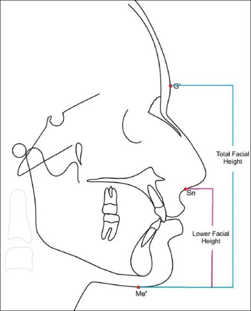 Tracing of lateral cephalogram showing proportional par | Open-i