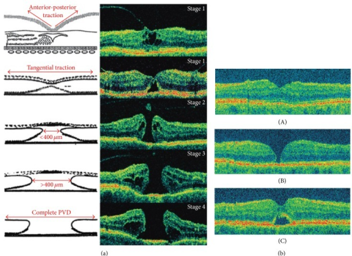 (a) Schematic and OCT representation of macular hole fo | Open-i