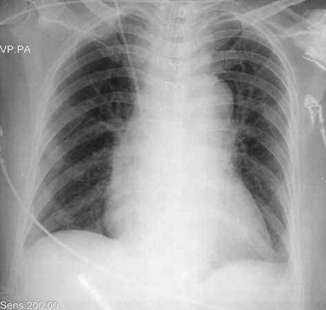 Chest X-ray showing mediastinal widening. | Open-i