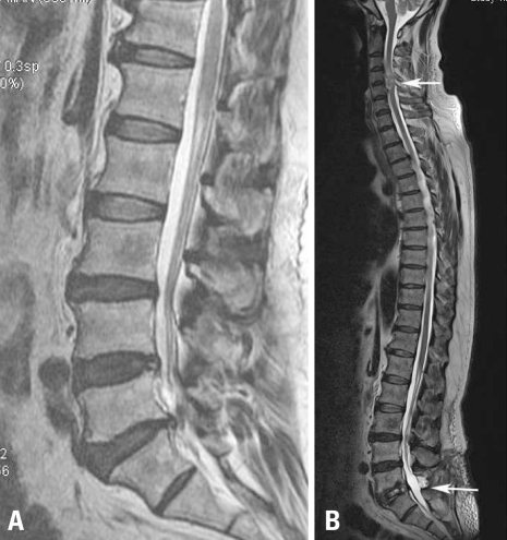 Lumbar magnetic resonance imaging (MRI) and whole spine | Open-i
