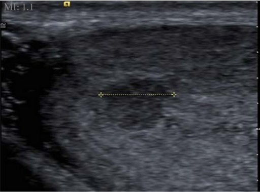 Utility Of Grayscale Ultrasound To Differentiate Benign